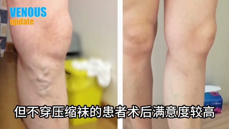 In the hot summer, patients with varicose veins who choose CHIVA surgery no longer need to endure the constraint of compression stockings